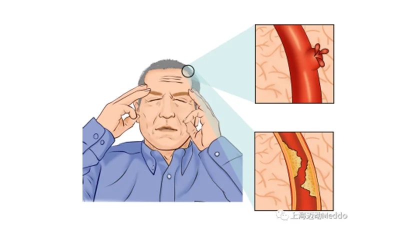 Must-Knows about Early Rehabilitation for Stroke-Induced Hemiplegia Patients